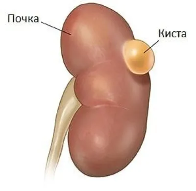 Пресакральные кисты — симптомы, диагностика, лечение