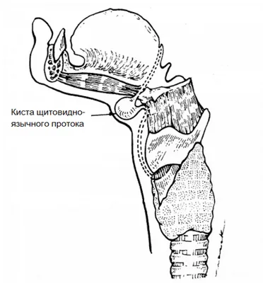 Киста яичников (лапароскопия яичников, удаление кисты яичников)