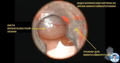 Как выглядит киста яичника? УЗИ и МРТ в диагностике разных видов кист