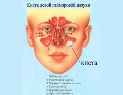 Киста головного мозга - причины, симптомы, диагностика и лечение  заболевания | Клиника Эксперт