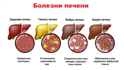 Цирроз печени. Симптомы, причины, лечение - Медицинский Диагностический  Центр \"Мое Здоровье\". МРТ Краснодар