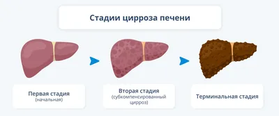 Лечение цирроза печени стволовыми клетками - Coolaser Clinic Киев