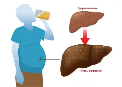 Цирроз печени: причины, признаки, симптомы и лечение