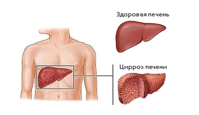 Цирроз печени – симптомы, первые признаки, причины, стадии и лечение у  женщин и мужчин