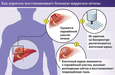 Причины возникновения цирроза печени: первые симптомы, стадии, профилактика  и лечение