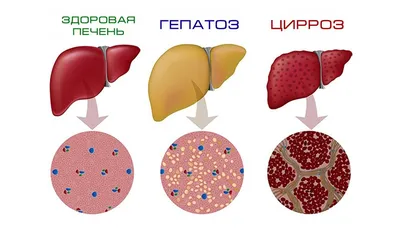 Цирроз печени: симптомы, признаки, методы лечения и препараты