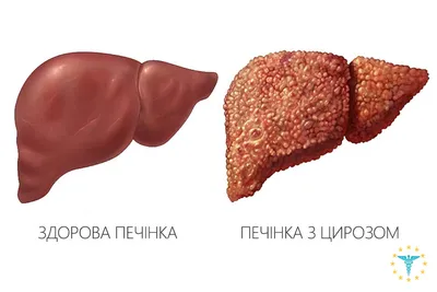 Циррозом печени болеют не только алкоголики: кто ещё в группе риска -  Рамблер/доктор