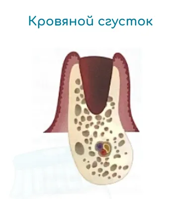 Лунка после удаления зуба на 14 день - Хирургия - Форум стоматологов  (стомотологический форум) - Профессиональный стоматологический портал  (сайт) «Клуб стоматологов»