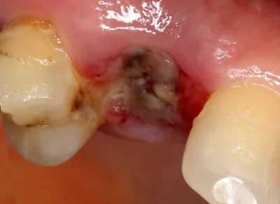Заживление лунки после удаления зуба - этапы, симптомы и возможные  осложнения, рекомендации