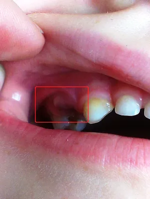 Фото лунки после удаления зуба на 3 день