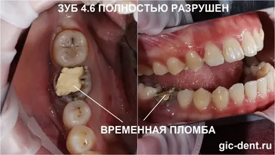 Атравматичное удаление зубов мудрости. Правила и рекомендации.