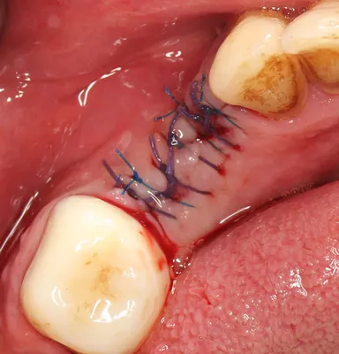 лунка после удаления 8-го зуба - форум Стоматология.Су