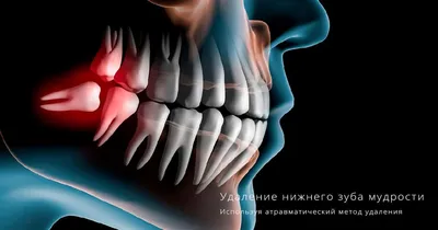 Удаления зубов мудрости - Хирургическая стоматология - Стоматология для всех