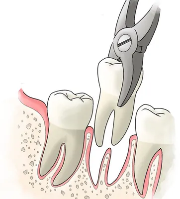 Удаление нижнего зуба мудрости [Цены, осложнения и уход после]