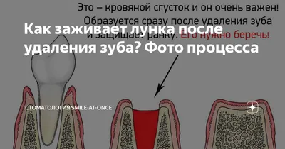 Лунка после удаления зуба мудрости - Хирургическая стоматология -  Стоматология для всех