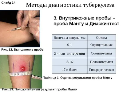 Принцип работы реакции Манту и Диаскинтеста один и тот же - метод кожной  пробы (иммунологического теста). Подкожно вводится микродоза… | Instagram