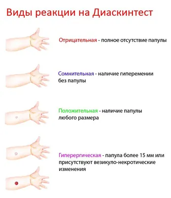 Диаскинтест - что это такое, как проводить, норма, противопоказания