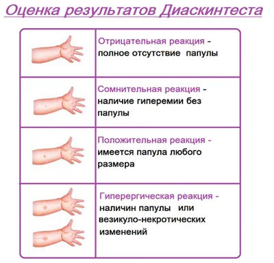 Отзыв о Внутрикожный диагностический тест Лекко \"Диаскинтест\" | Бывает  ложноположительный