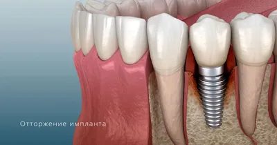 Фото отторжения импланта зуба