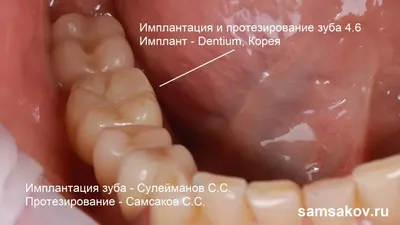 Как определить, прижился ли имплант зуба или нет?