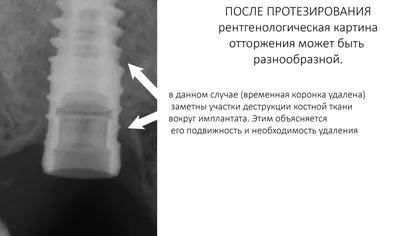 Корейский имплант Дентиум не хуже немецких или швейцарских имплантов