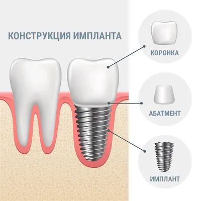 Отторжение Импланта 1 Зуба Фото Срок Службы ЛюмиДент