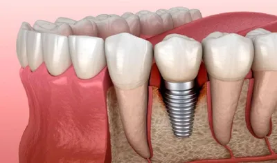 Сколько служит имплант зуба? - Дентум Стоматология