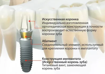 Имплантация зубов в Киеве – Стоимость и отзывы ᐈ Certus | Certus