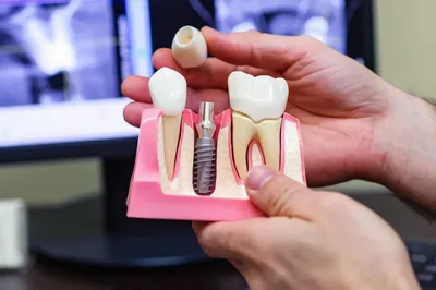 Имплантация зубов виды и цены - Cтоматология Май