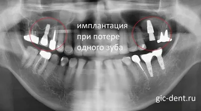 Отторжение импланта зуба | Сеть стоматологий InnДента | Дзен