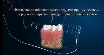 Когда нужно делать имплантацию зубов и костную пластику - Немецкий  имплантологический центр