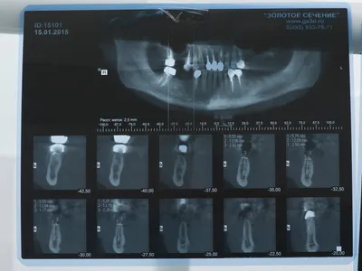 Замена зубных имплантов в стоматологии в Москве, цены