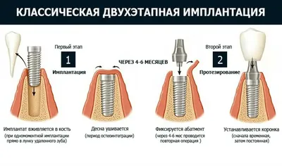 Виды и цены зубных имплантов – что это такое, классификация