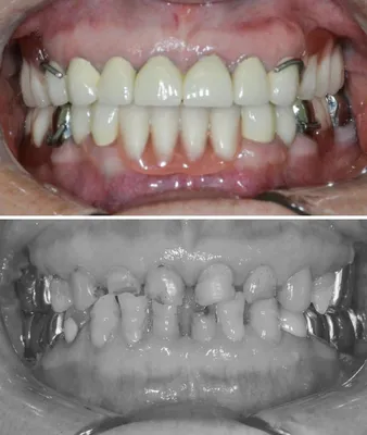 Фото отторжения импланта зуба
