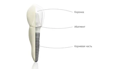 Современные методы имплантации зубов в Москве. Технологии современной  импланталогии, установка импланта по хирургическому шаблону, фото