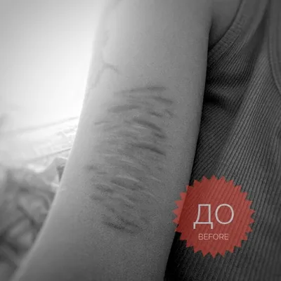 Перекрытие шрамов в Пензе - Татуировки - Красота: 12 тату-мастеров со  средним рейтингом 4.9 с отзывами и ценами на Яндекс Услугах