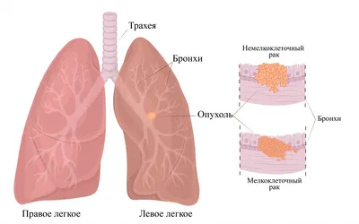 БФ Помоги ребенку.ру - Алексей Отрадных. Новый сбор У Алексея воспаление  легких, которое ну никак не проходит... Это осложнение после проведенной  операции на сердце. А до этого было удаление абсцесса головного мозга.