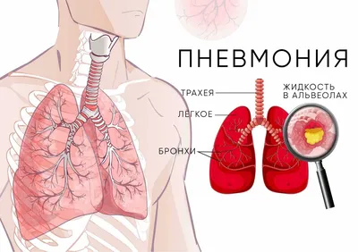 Рентген легких после операции. | Портал радиологов