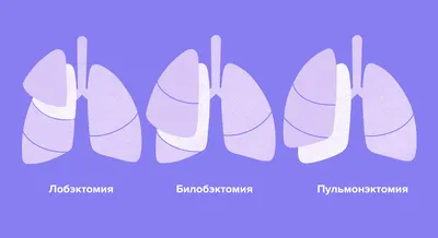 Пульмонологи оценили риск появления рубцов в легких после COVID-19 — РБК