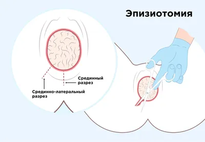 Фантом для ушивания эпизиотомии. Виртумед.