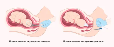 Интимное восстановление после родов