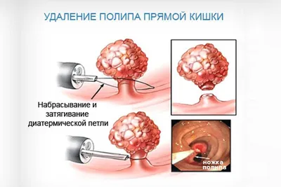 Кожа и бахромки вокруг ануса после удаления геморроя - YouTube