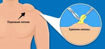 Удаление липомы по низким цены в Москве лазером, хирургическим методом,  криодеструкция и другие