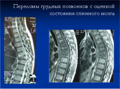 Позвоночный столб: анатомия простым языком.Анатомия позвонка человека