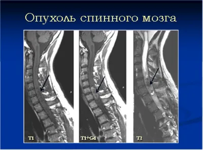 Сколиоз у детей — причины, виды, правильная диагностика сколиоза у ребенка  - Национальный медицинский исследовательский центр детской травматологии и  ортопедии имени Г. И. Турнера - официальный сайт