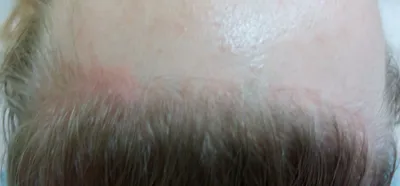 Аллергическая опрометчивая кожа Eczema дерматита на ноге пациента Кожа  псориаза и Eczema с большими красными пятнами Стоковое Фото - изображение  насчитывающей разлад, дерматологическо: 105412142