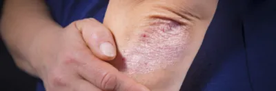 Псориаз на конце-вверх, скальпе, фото дерматита и Eczema кожи, проблемах  кожи, дерматологии Стоковое Изображение - изображение насчитывающей  дерматология, разлад: 97353173