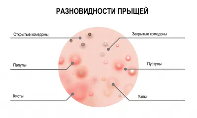 Прыщи на лице - причины появления, при каких заболеваниях возникает,  диагностика и способы лечения