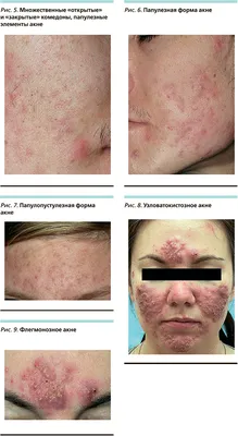 Патч (пластырь) против прыщей COSRX Acne Pimple Master Patch - «Работают с  прыщами. Слабенькие для подкожников. Другие разновидности высыпаний  тестированию не подвергались» | отзывы