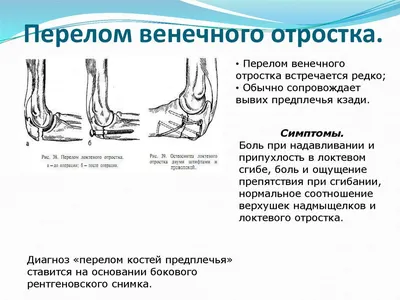 Что делать, если сломал руку? - полезные статьи от специалистов -  Медицинский центр «АудиоМед»